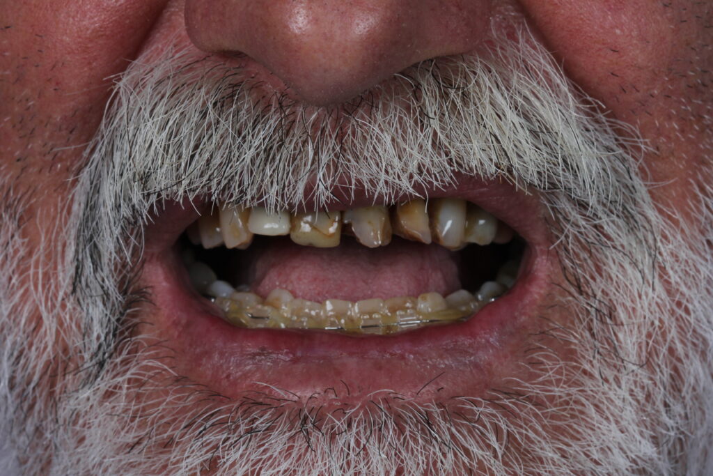 Antes do tratamento de implante dentário no Instituto Joie, Botelhos MG