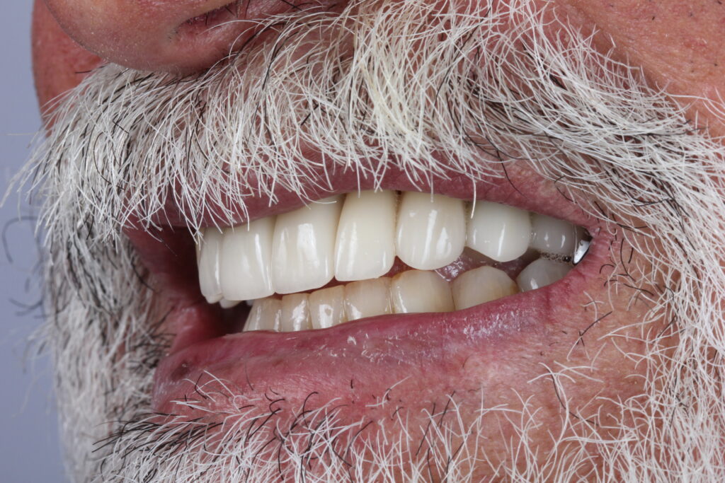 Depois do tratamento de implante dentário no Instituto Joie, sorriso transformado