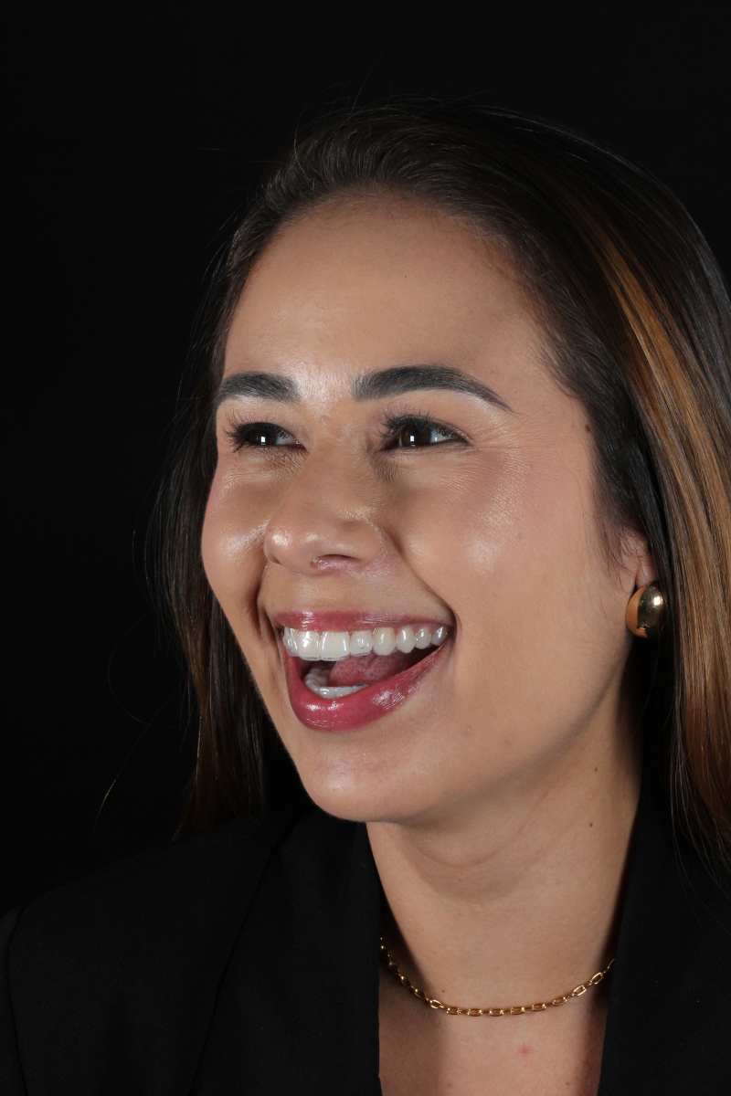 Paciente sorrindo com alinhador invisível em consultório odontológico, ilustrando tratamento de ortodontia moderna em Botelhos-MG.