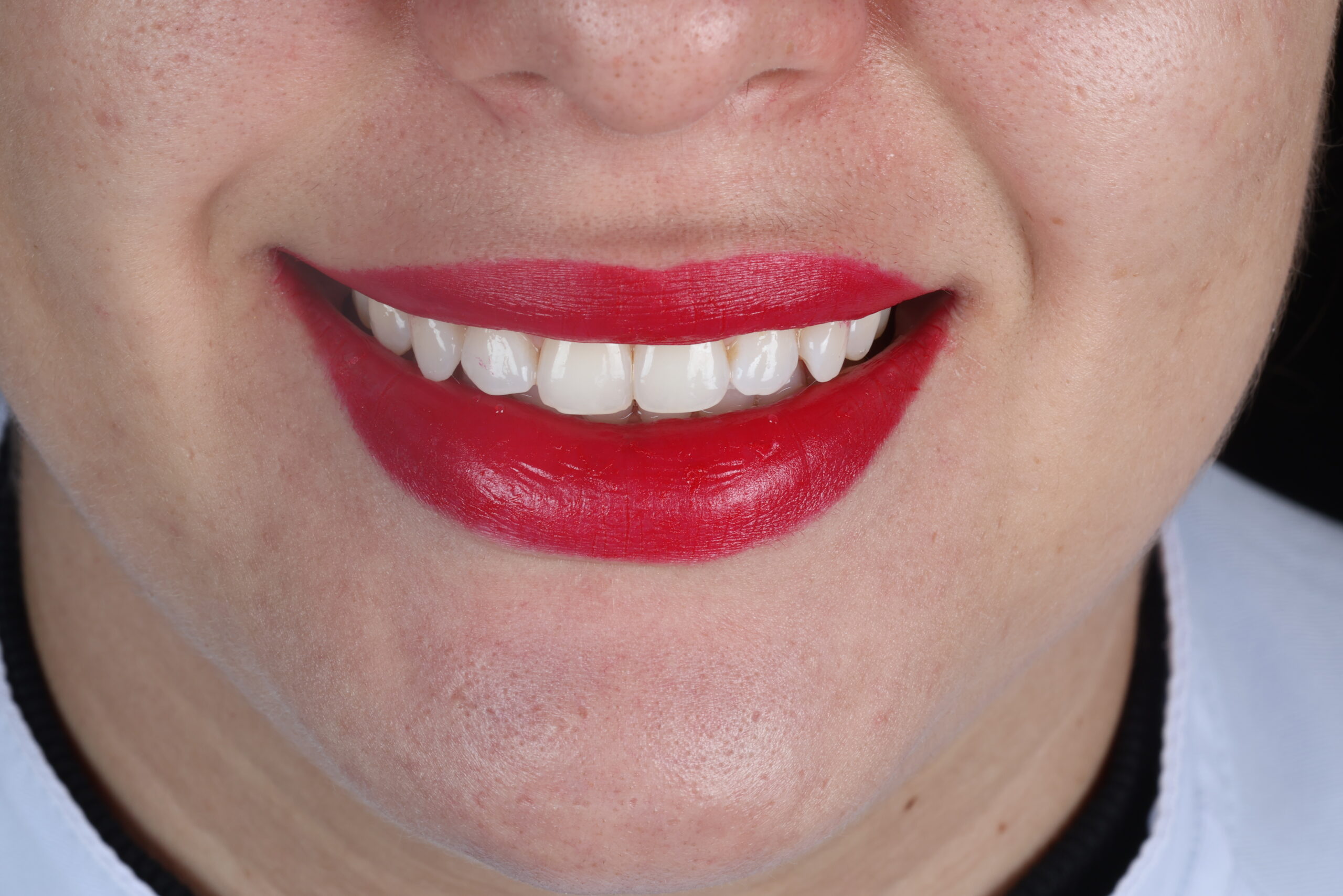 Paciente durante avaliação periodontal em consultório odontológico para prevenção e tratamento de doenças da gengiva em Botelhos-MG.